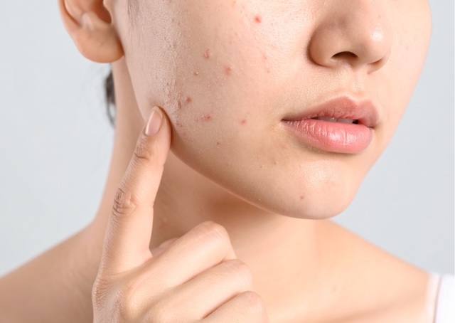 Bare glowing summer skin by looking out for these common skin woes MakatiMed